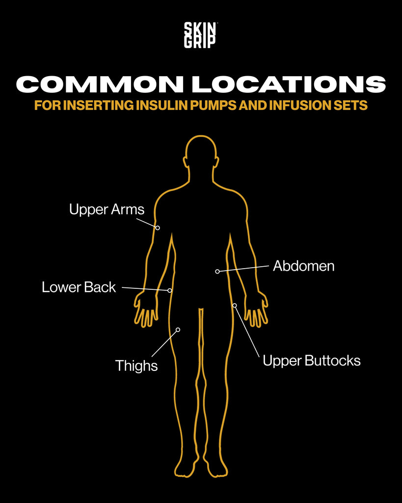 best location for insulin pump infusion sets infographic