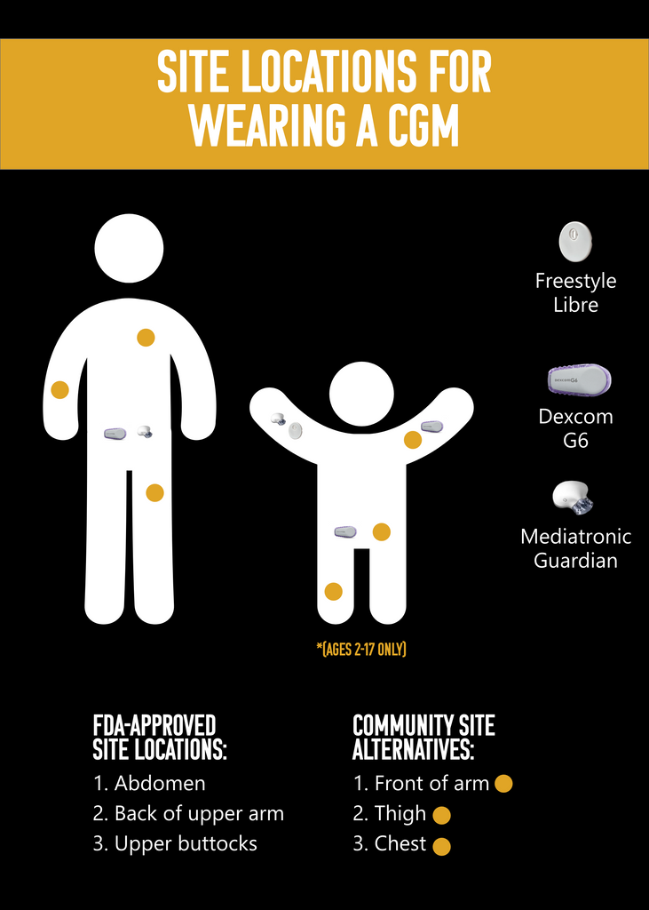 infographic on site locations for dexcom g6 sensor