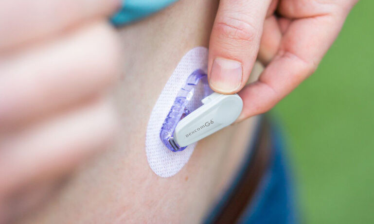 image of dexcom g6 sensor insertion