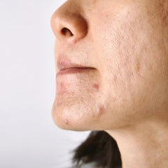 Acne scars