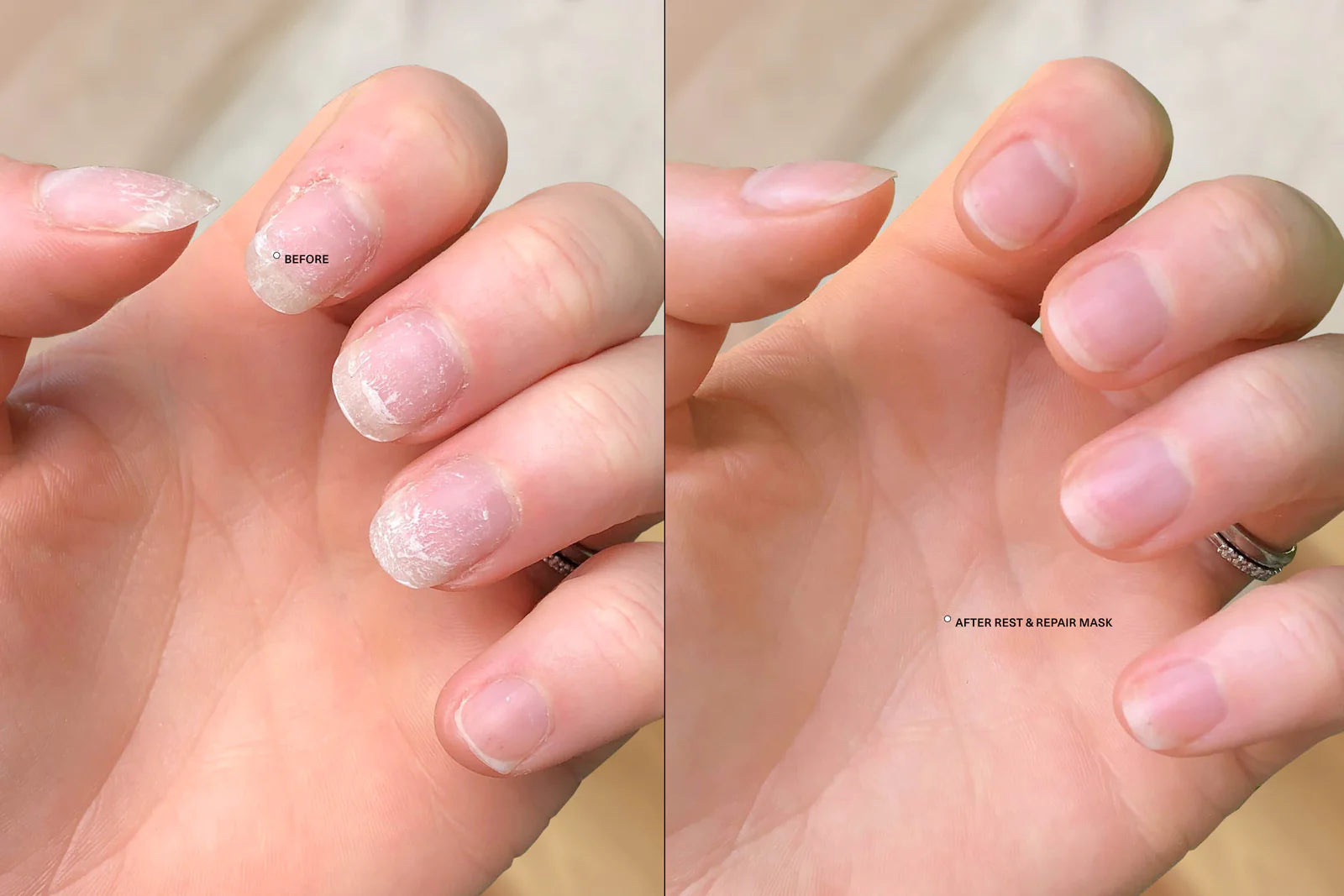 Nail Psoriasis: Causes, Symptoms, Diagnosis, Treatment