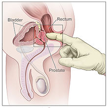 prostate diagramme