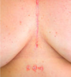 Coverup of a rather large open heart surgery scar