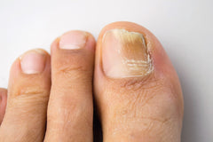 Fungal Nail