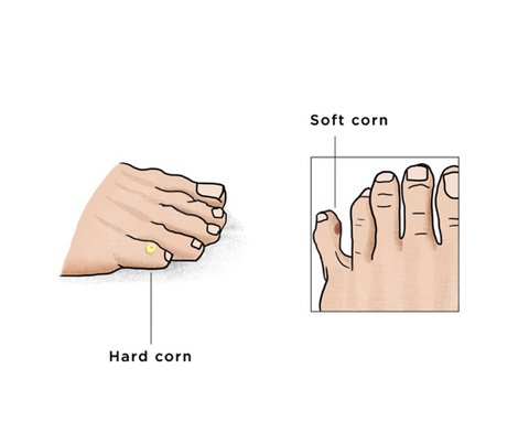 soft corns treatment
