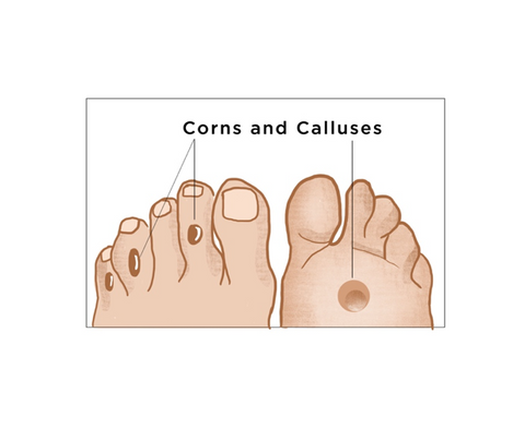 get rid of corns on feet