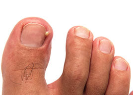 scholl ingrowing toenail