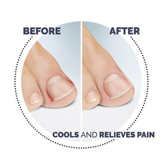 scholl ingrowing toenail treatment