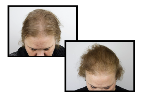 AnteAGE MD Hair Growth Factor Solution Before and After