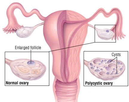 PCOS Ovary image