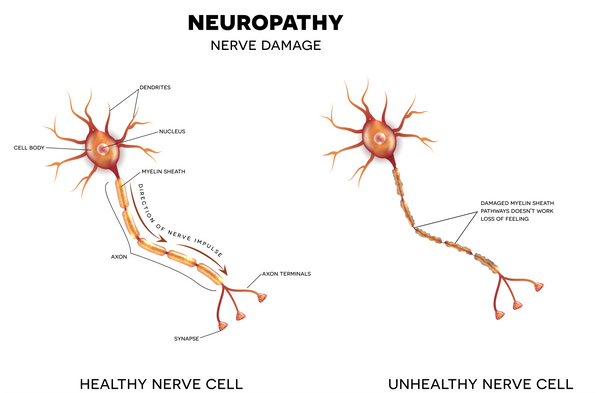 red light therapy for neuropathy