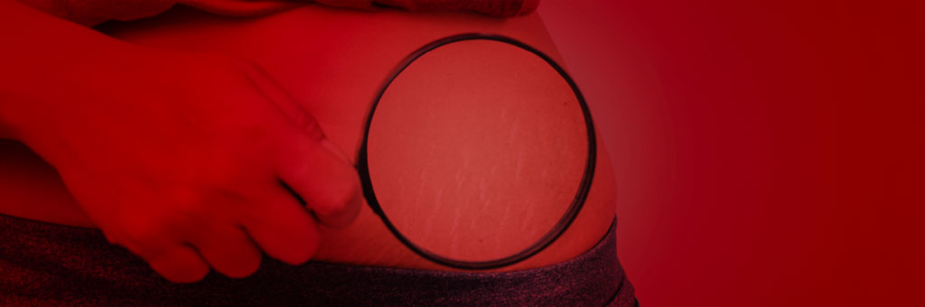 red light therapy for stretch marks