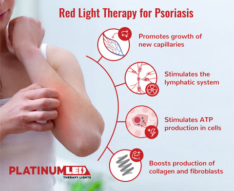 Red light therapy for psoriasis