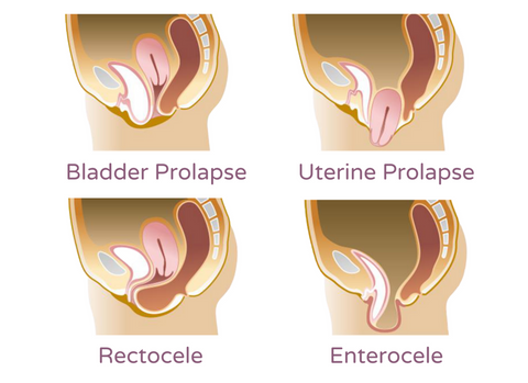 Different Types of Pelvic Organ Prolapse