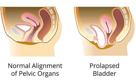 What is Bladder Prolapse (Cystocele) - FemiCushion UK