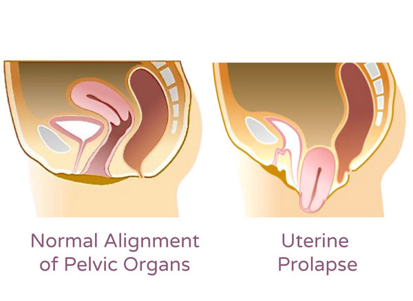 What Are the Early Symptoms of Uterine Prolapse?, Doctor's Advice