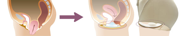 Pelvic Organ Prolapse treated by FemiCushion