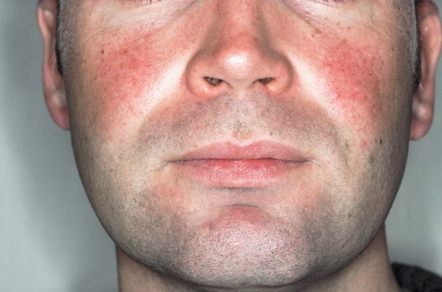 how-to-clear-rosacea