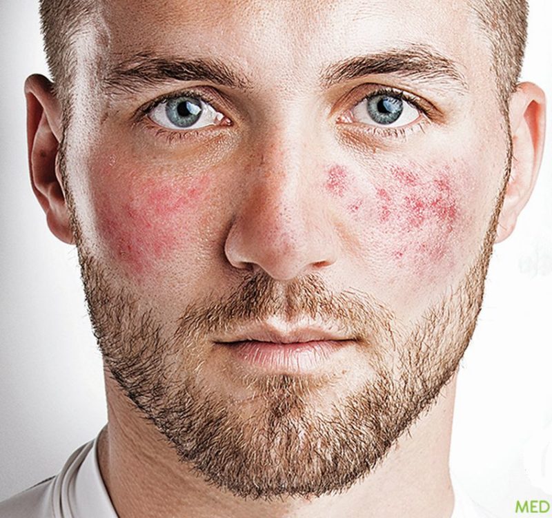 what-is-rosacea