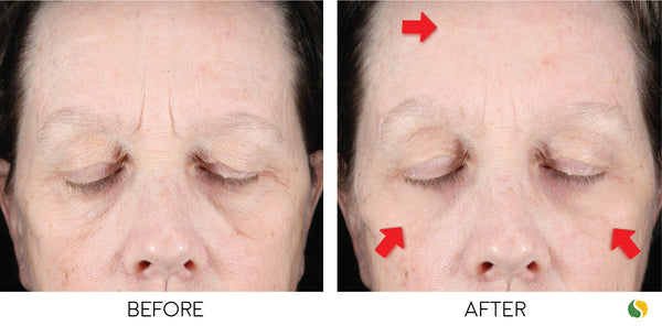before and after pictures of instant eye bag treatment