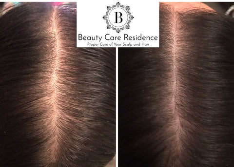 Natural Hair Growth Stimulation Toronto | Beatuy Care Residence