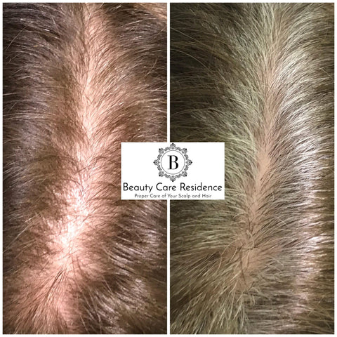 Hair & Scalp Treatment Toronto | Before & After | Beauty Care Residence