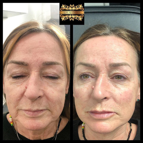 before and after photo of anti aging treatments