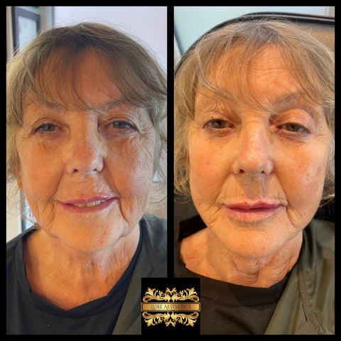 before and after photo of anti aging treatments