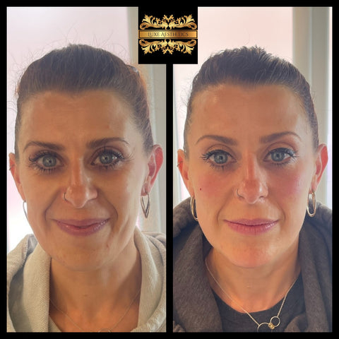 Transformation before and after photograph of a lady following anti aging treatments