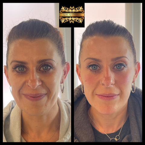 before and after photo of anti aging treatments