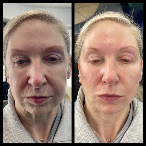 before and after photo of anti aging treatments