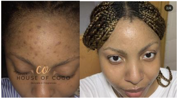 03- Hello Clear Skin â€“ House of Coco Skincare