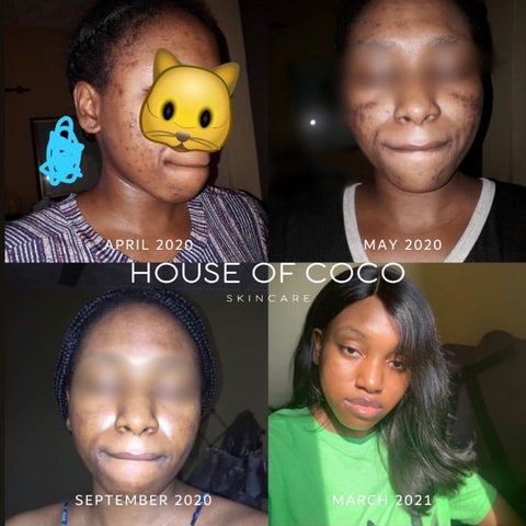 04- TOTAL TRANSFORMATION! â€“ Page 2 â€“ House of Coco Skincare