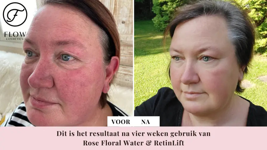 Natuurlijk middel tegen rosacea