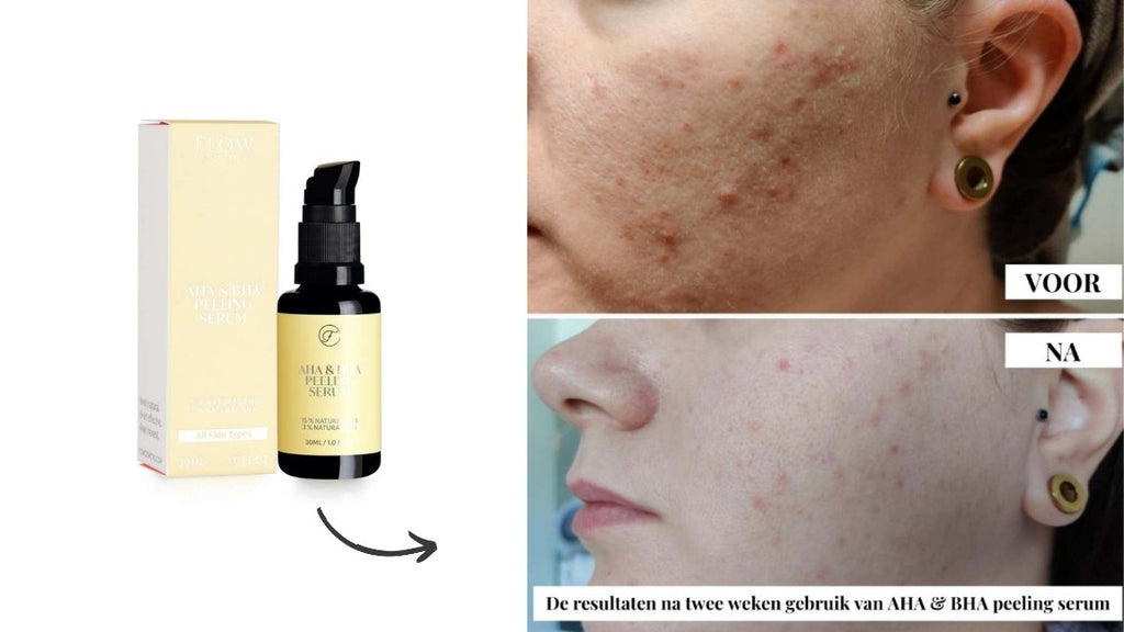 zakdoek Klein groet De beste natuurlijke producten tegen acne – Flow Cosmetics
