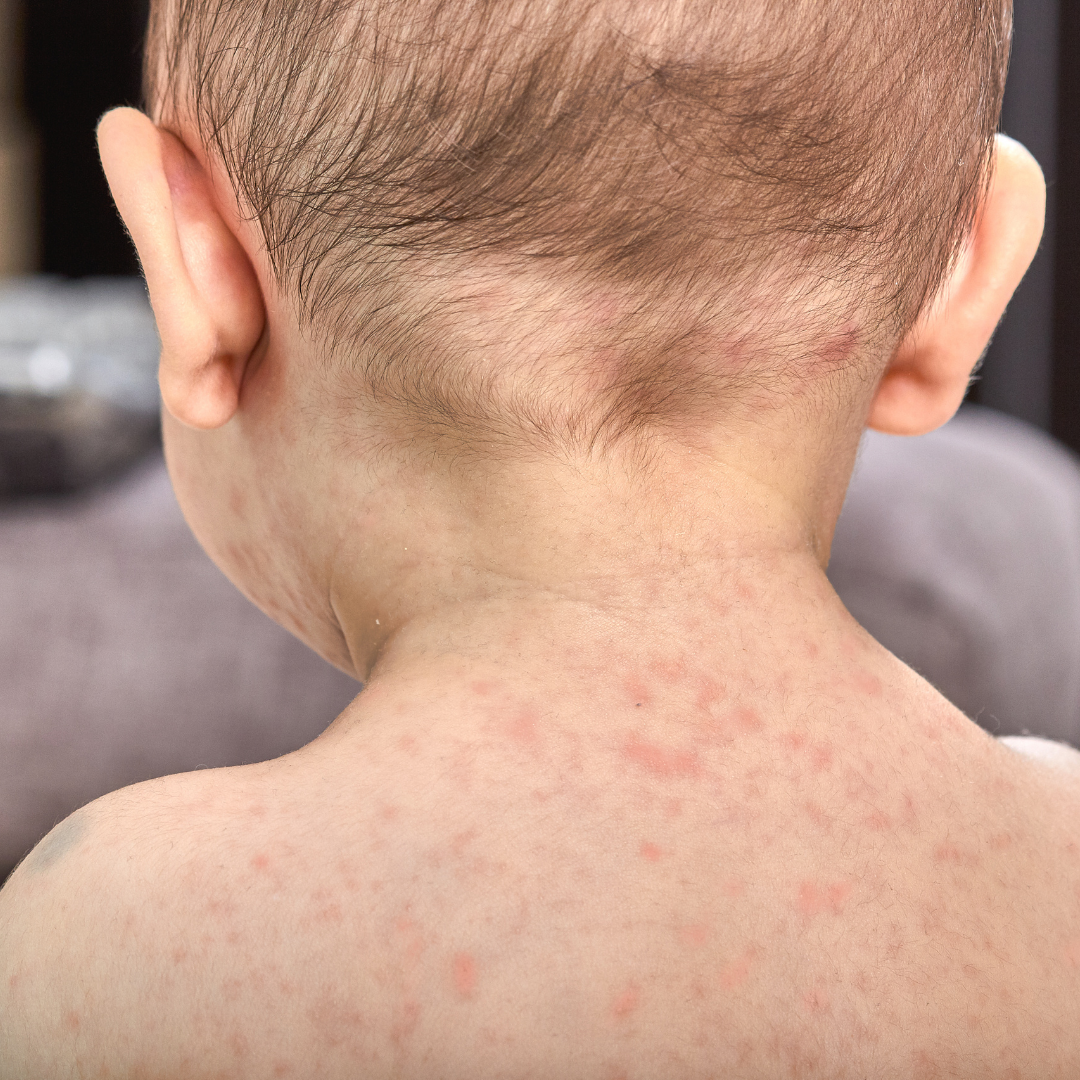 what-is-roseola-or-sixth-disease-ready-set-food