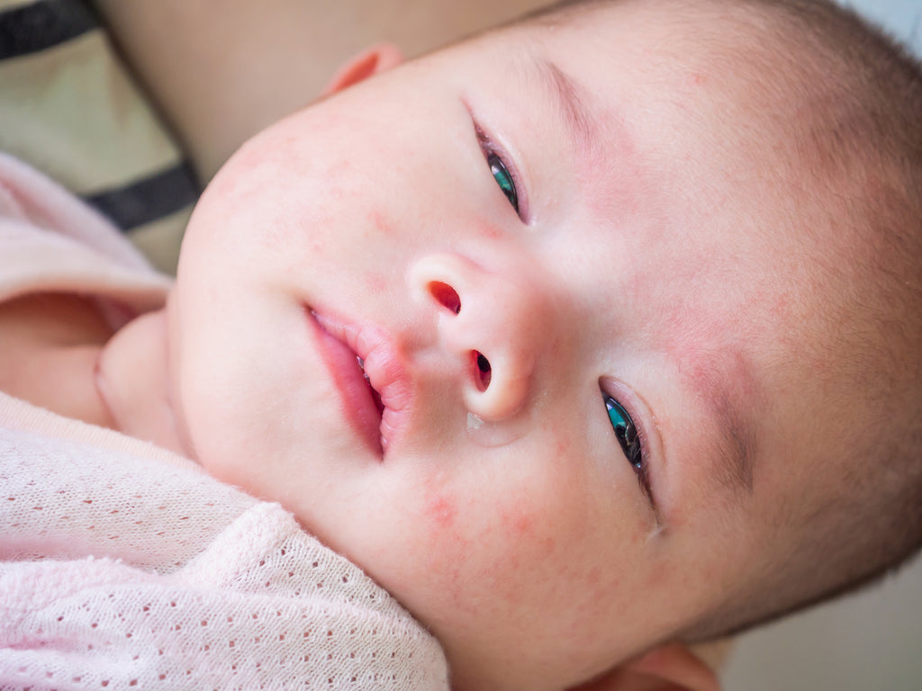 Baby Eczema And Food Allergies