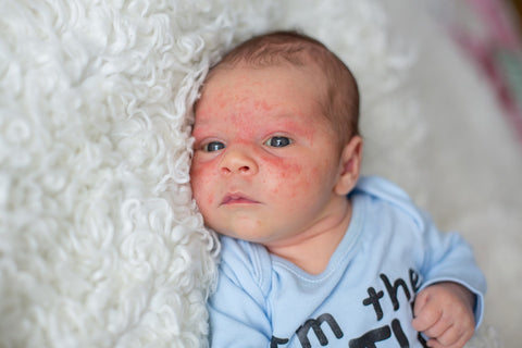 itchy eczema rash on baby face
