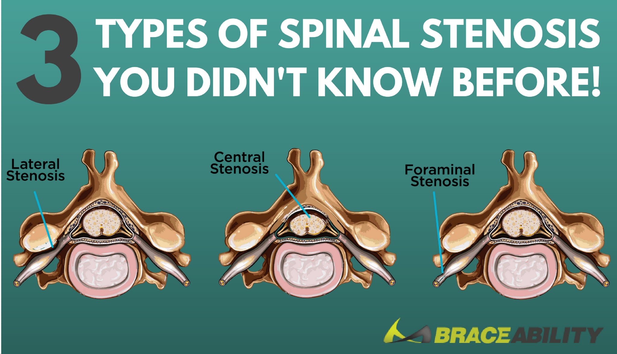 Does Cervical Stenosis Cause Leg Pain