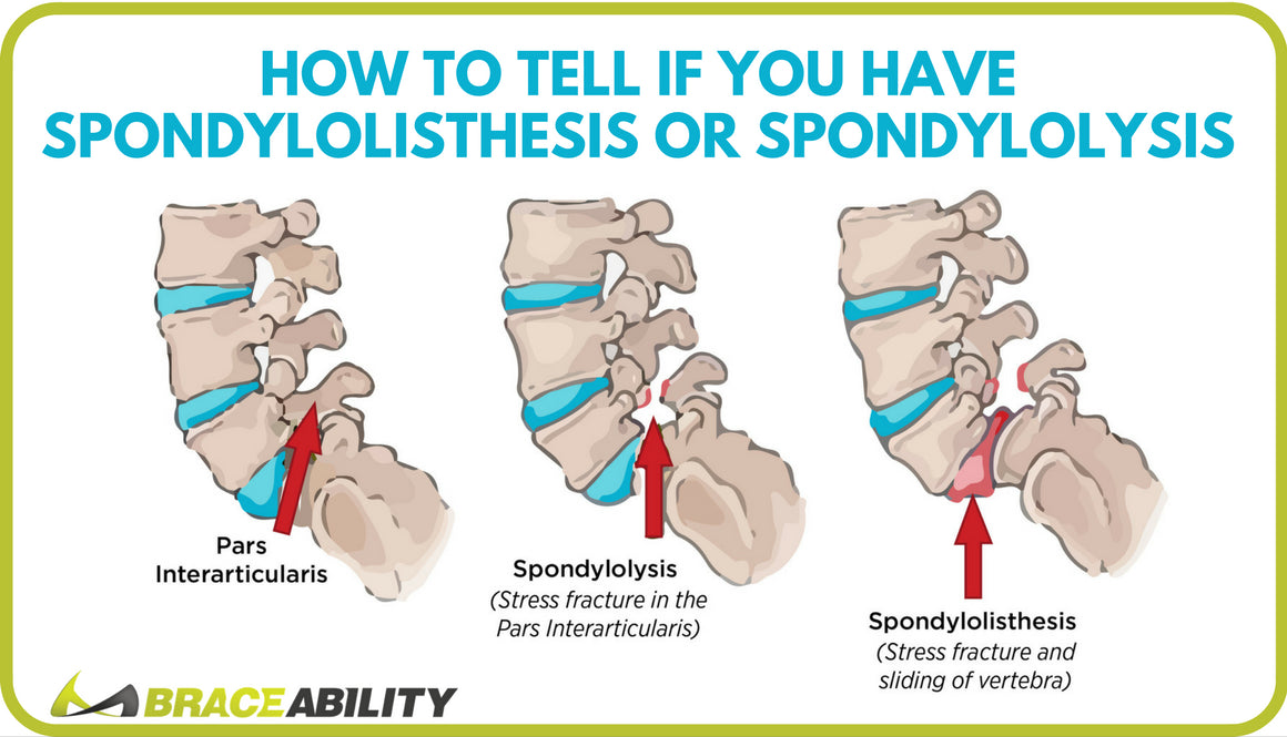 spondylolisthesis symptoms nhs