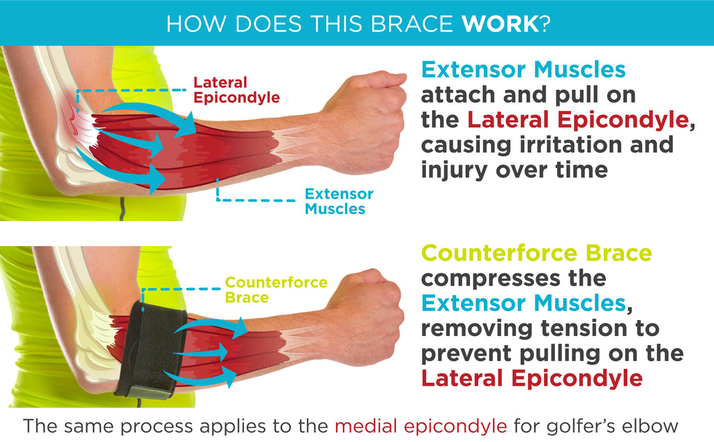 The counterforce tennis elbow brace applies compression to the epicondyle