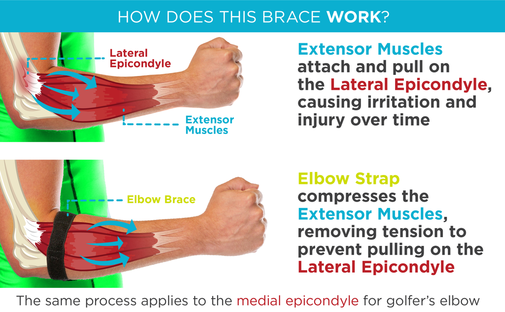 Medial Epicondylitis Brace Placement