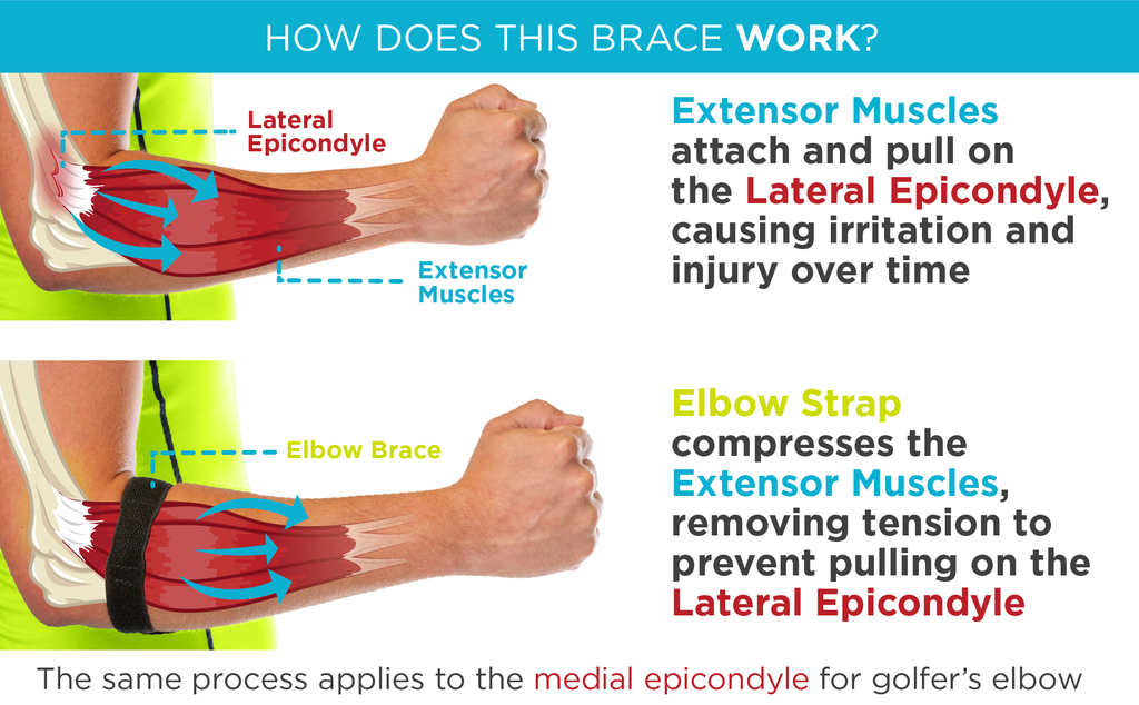 How does an epicondylitis brace work to treat medial and lateral epicondylitis
