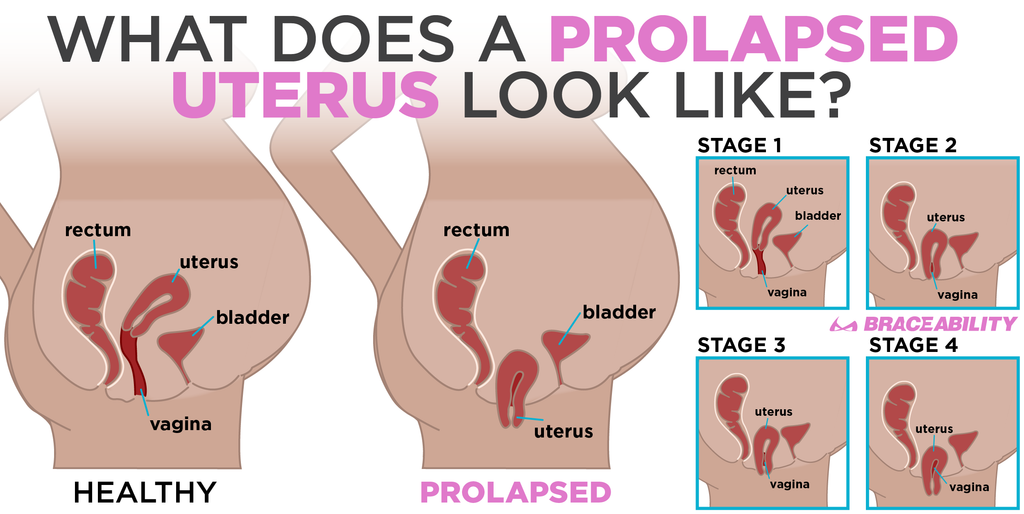What does a prolapsed uterus look like?
