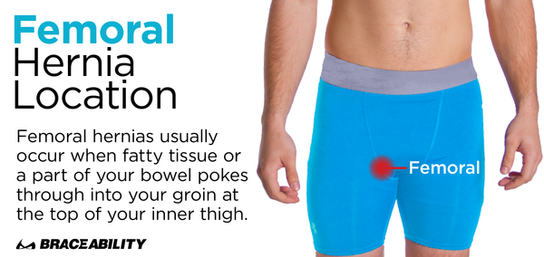 a femoral hernia happens on the inner part of a males thigh near the groin