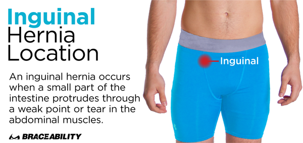 an inguinal hernia occurs near the band of mens underwear at a weak point in the abdominal muscle