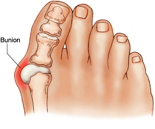 Anatomy of your toe joint where bunion pain happens