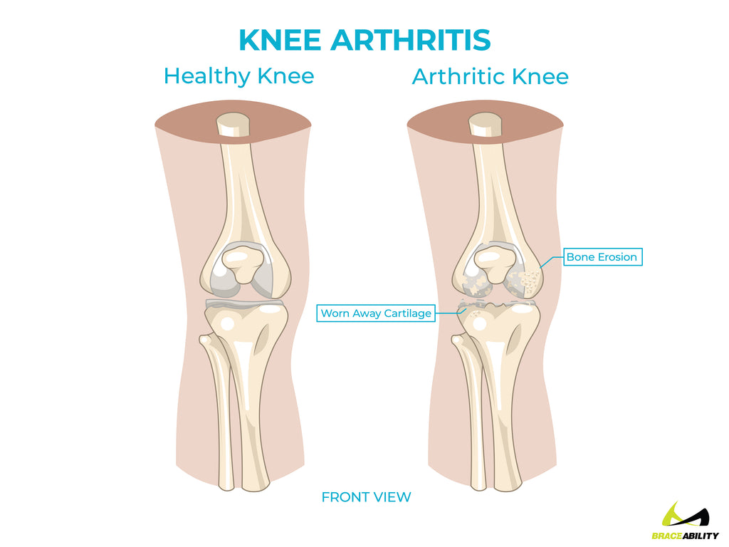 anatomy of knee arthritis causing back of knee pain