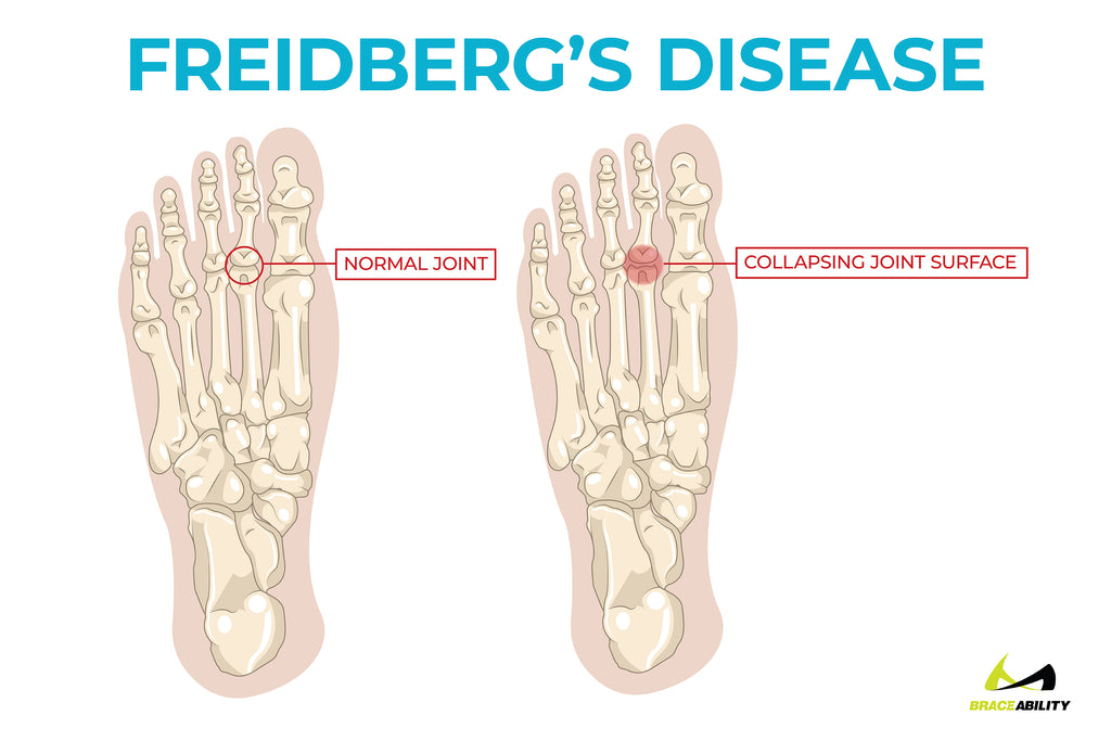 learn about Freidberg's Disease and how it causes ball of foot pain