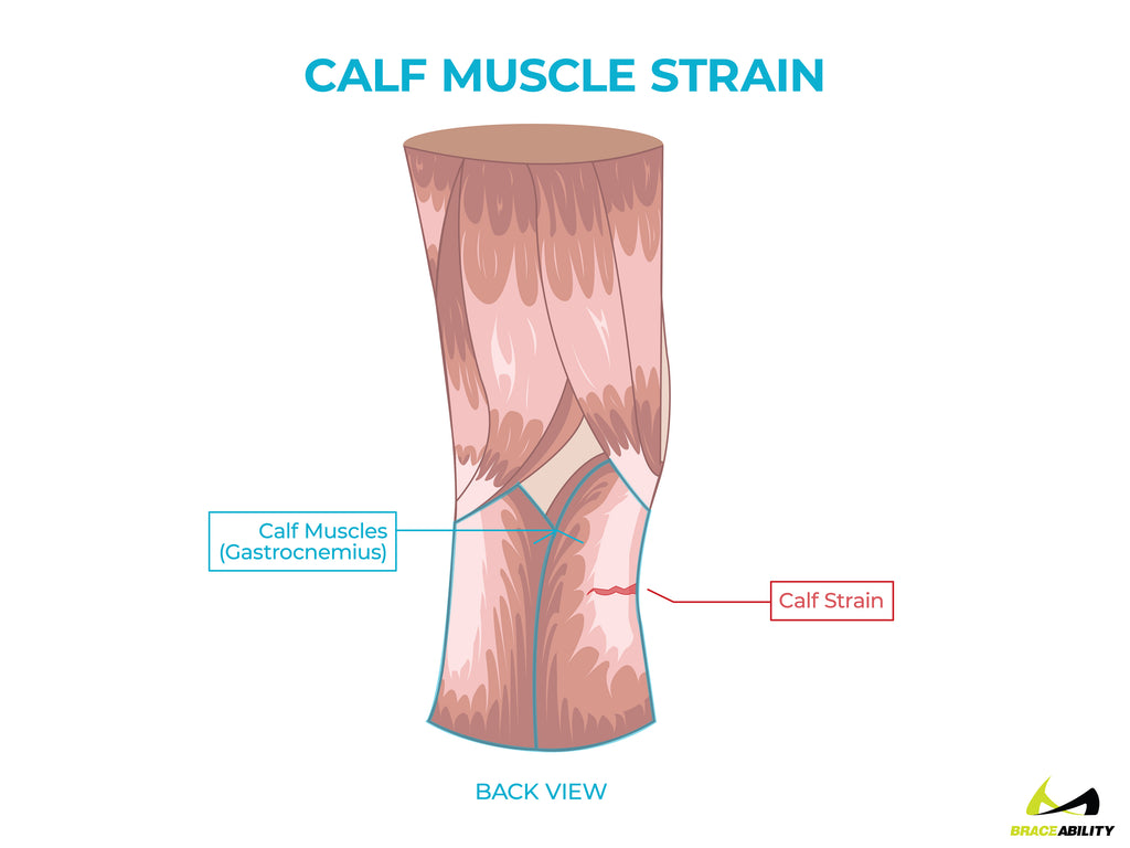 anatomy of a calf muscle strain or gastrocnemius tendonitis